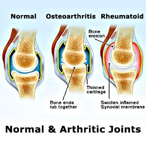 Arthritis Knee Pain