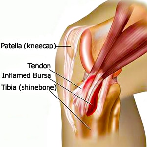 Medial Knee Pain