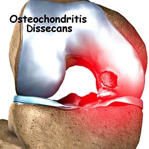Osteochondritis Dissecans Knee Condition