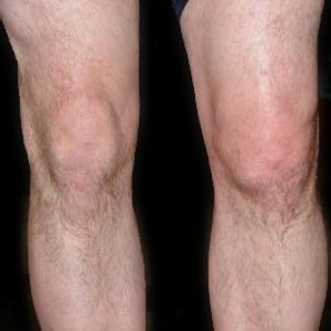 Water-on-the-Knee-Knee-Effusion