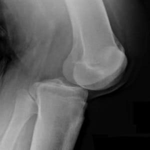 Dislocated kneecap